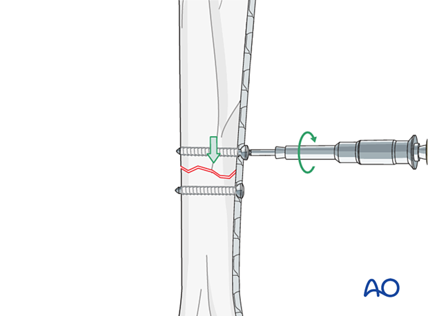D12_P030_i160_A3 The second screw is inserted after drilling with a load guide on the other side of the fracture