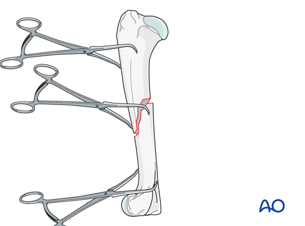 Fracture reduction