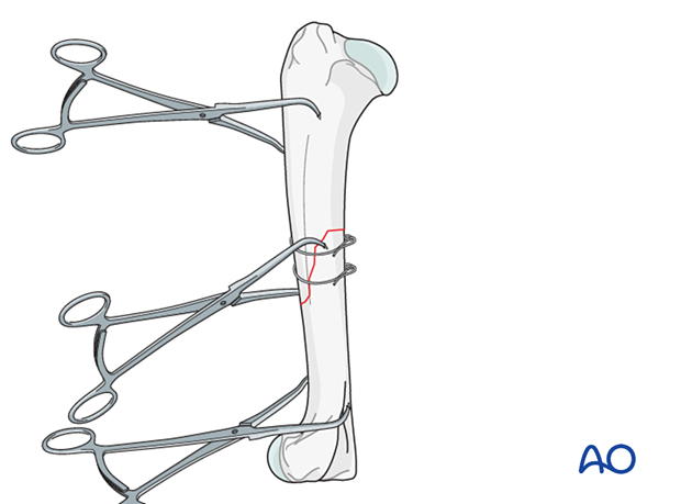 The fracture is stabilized with at least two cerclage wires