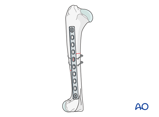 Two screws, one in the proximal fragment and one in the distal fragment, are inserted