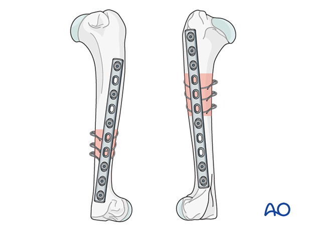 The plate is applied to the lateral surface for more proximal fractures or the medial surface for more distal fractures