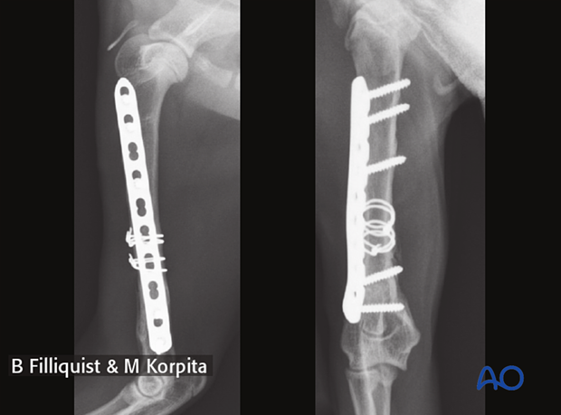 Follow-up radiographs six weeks after surgery