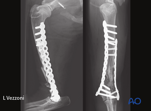 Postoperative radiograph