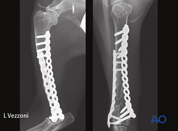 Follow-up radiographs six months after surgery