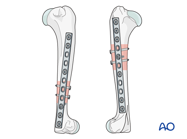 The plate is applied to the lateral surface for more proximal fractures or the medial surface for more distal fractures