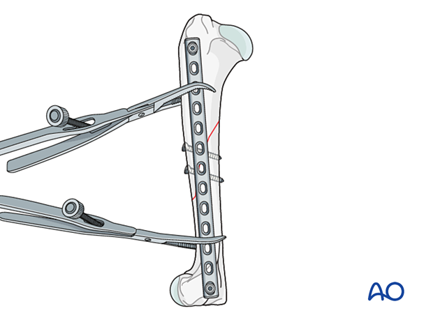 Two screws, one in the proximal fragment and one in the distal fragment, are inserted