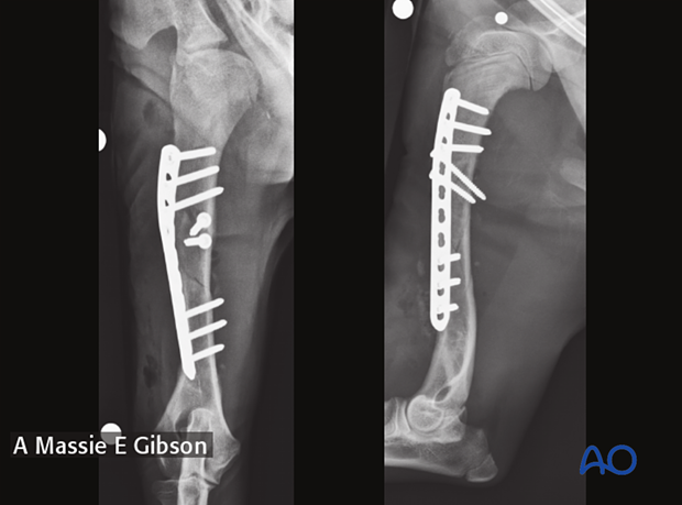 Postoperative radiographs