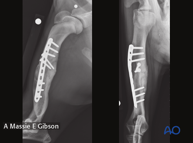 Follow-up radiographs four weeks after surgery