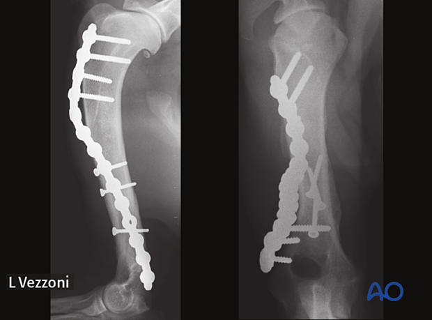 Follow-up radiographs at six weeks