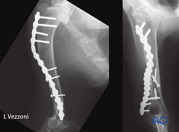 Follow-up radiographs at three months