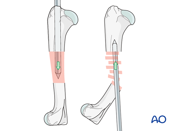 The IM pin can be inserted in either an antegrade or retrograde fashion