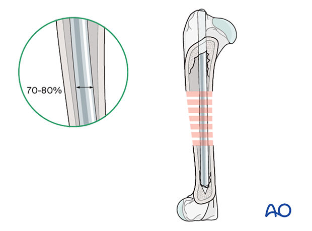 The IM pin diameter should be 70-80 % of the isthmus of the medullary canal