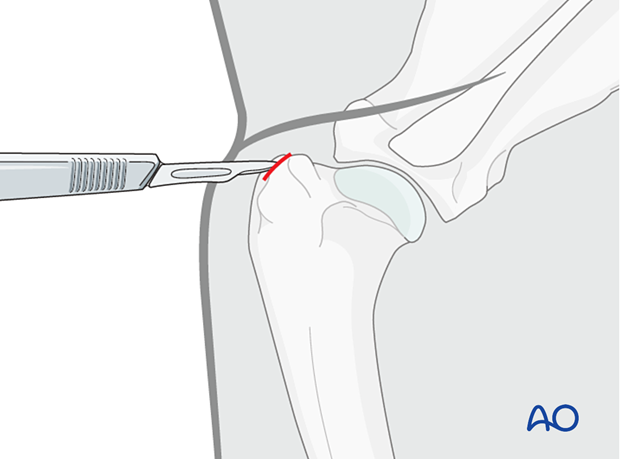 A 1 cm stab incision is made directly over the craniolateral point of the greater tubercle