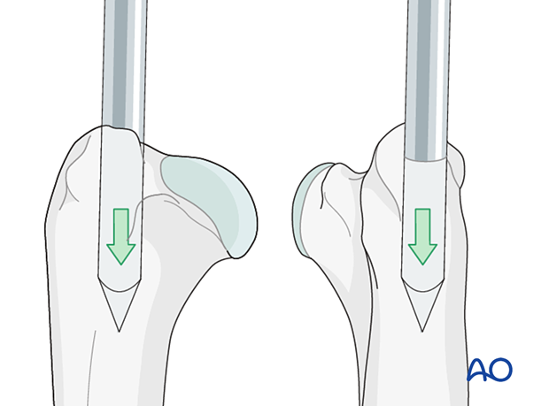 The IM pin enters the bone on the lateral slope of the ridge of the greater tubercle near its bas