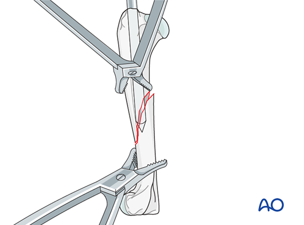 Bone holding forceps are applied to the proximal and distal fragments for distraction