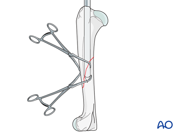 The fracture is preliminarily fixed with one or two pointed reduction forceps