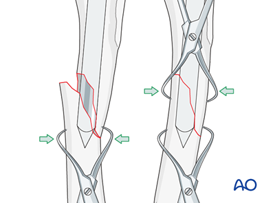 Intramedularry Pin Cerclage wires and intramedullary pin for Simple oblique fracture of ...