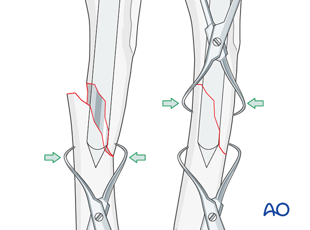 The bone fragments are pulled, toggled, or levered along the fracture line into perfect anatomical reduction