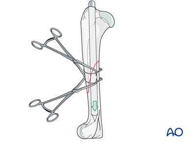 Intramedularry Pin Cerclage wires and intramedullary pin for Simple oblique fracture of ...