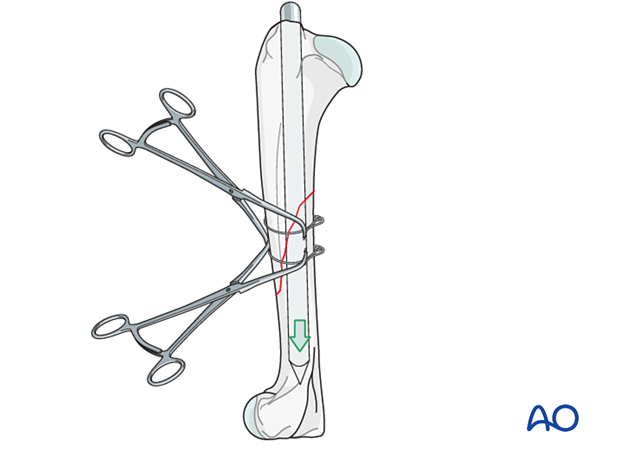 The IM pin is advanced until just proximal to the supratrochlear foramen