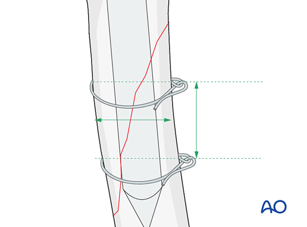 The cerclage wires should be placed at least ½ bone diameter from the tip of the fragment and ½-1 bone diameter from each other