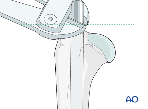 The protruding IM pin is cut close to the greater tubercle