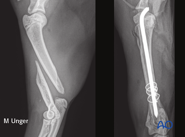 Postoperative radiographs