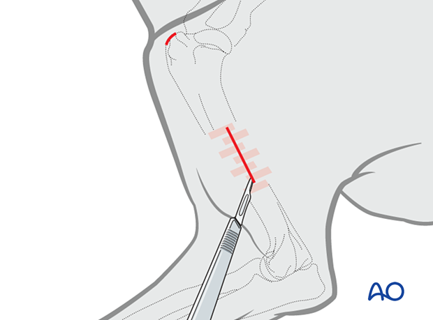 P070 cerclage wires and intramedullary pin