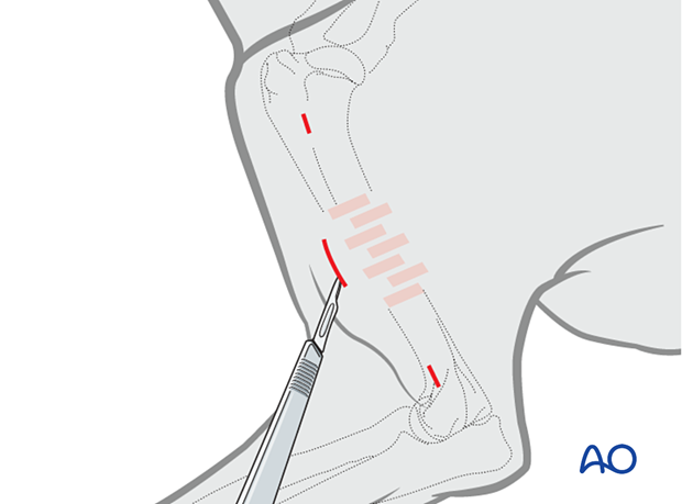 For retrograde insertion, a small approach over the fracture zone can be used with two separate small approaches for screw/bolt placement, proximal and distal