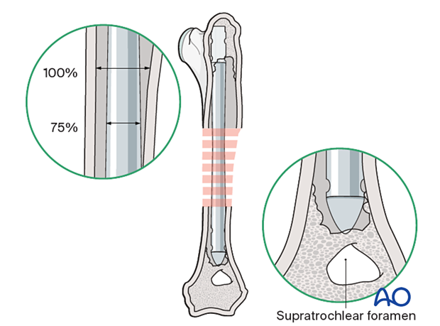 The nail’s largest diameter should be approximately 75% of the medullary cavity