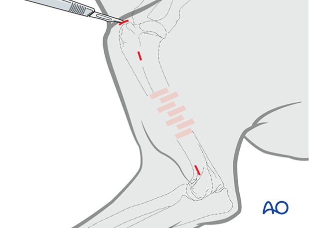 For antegrade insertion, a small approach to the greater tubercle is necessary