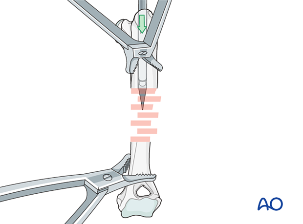 The medullary cavity is opened using an intramedullary pin or a dedicated awl