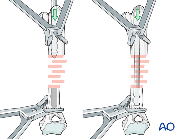 The nail is directed to the fracture site and after reduction directed into the distal fragment