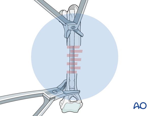 Reduction is confirmed using local landmarks and/or intraoperative fluoroscopy