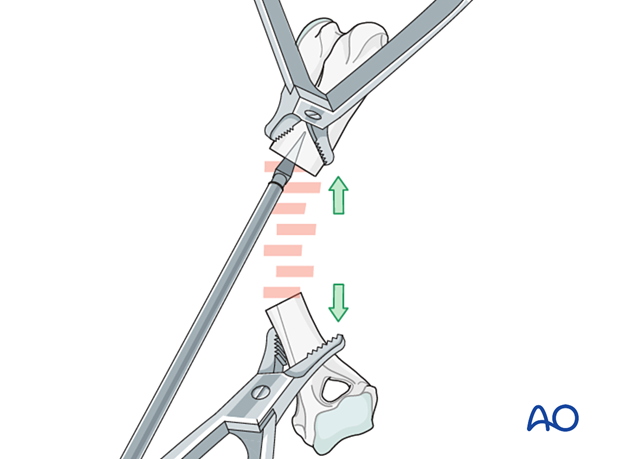 The medullary cavity is opened using an intramedullary pin or a dedicated awl