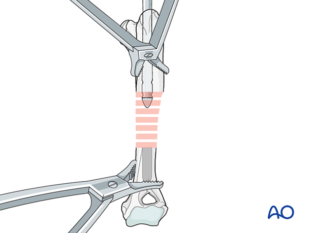 The fracture is reduced manually or with the help of reduction forceps