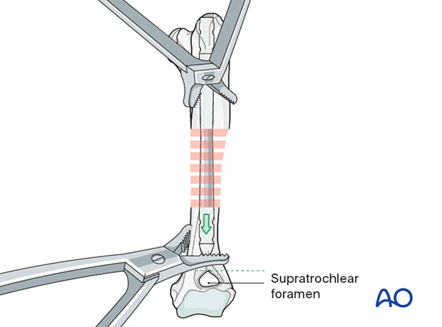 The nail is advanced into the distal fragment just proximal to the supracondylar foramen