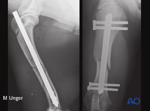 Postoperative radiographs