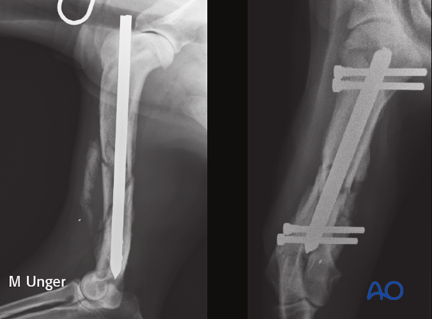 Follow-up radiographs six weeks postoperative