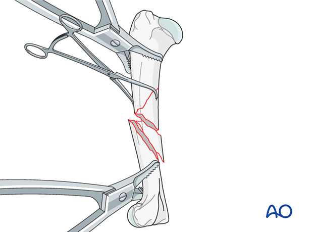 The fracture is reduced to one fragment and kept in reduction by pointed reduction forceps