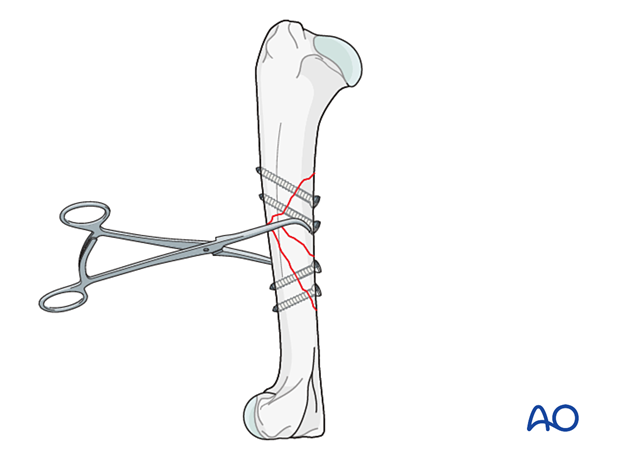 approach to the le fort i level of the midface in cleft lip and palate patients