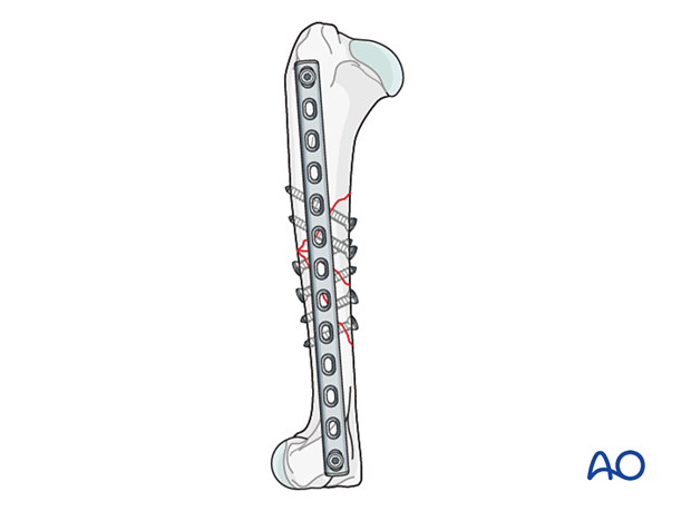 Two screws, one in the proximal fragment and one in the distal fragment, are inserted