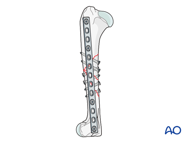 The first four screws are inserted in an alternating fashion to fix the alignment