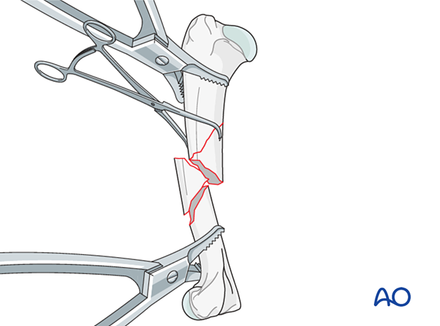 The fracture is reduced to one fragment and kept in reduction by pointed reduction forceps