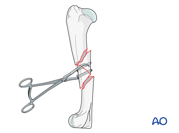 approach to the le fort i level of the midface in cleft lip and palate patients