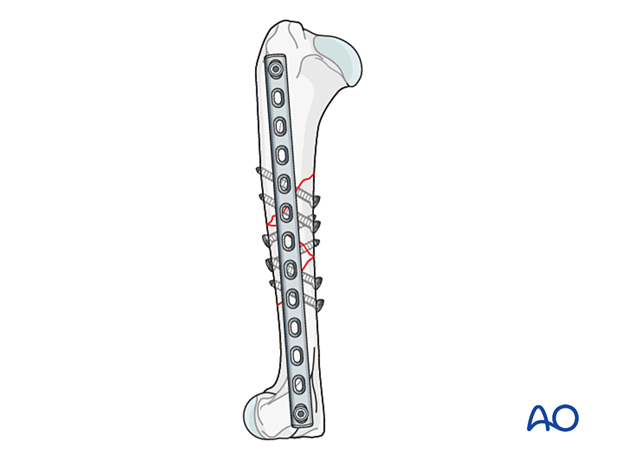 Two screws, one in the proximal fragment and one in the distal fragment, are inserted