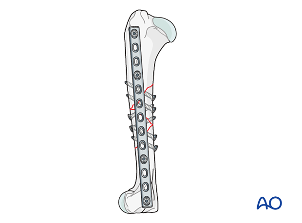 The first four screws are inserted in an alternating fashion to fix the alignment