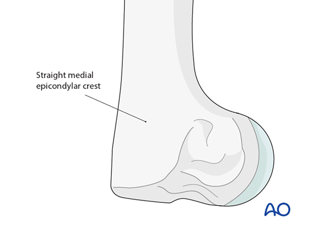 In dogs, for fractures where the plate should reach far distal, a medial plate