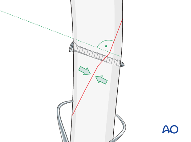 approach to the le fort i level of the midface in cleft lip and palate patients