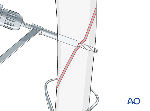 A glide hole is first drilled through the cis-cortex, followed by the thread hole in the trans-cortex